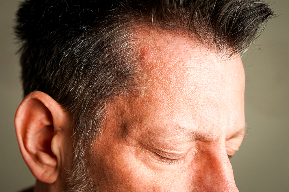 Přenosné RLT pero s modrým světlem proti akné